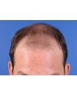 Before Hair Transplant&nbsp;2 Sessions (Areas)